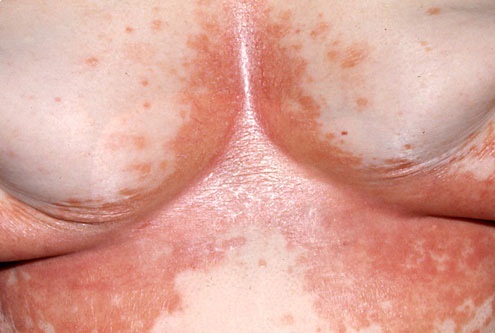 Erythrasma (Nhiễm trùng da mạn tính) - Hình ảnh minh họa